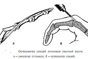 osteosinteza osului metacarpal