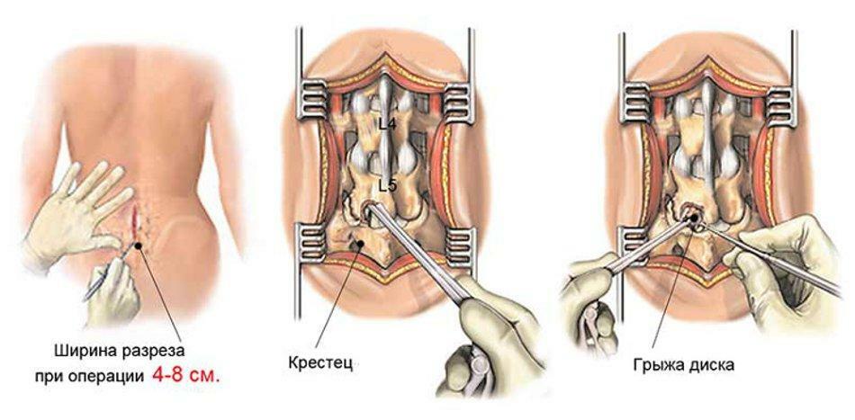 The course of the operation to remove a hernia on the spine
