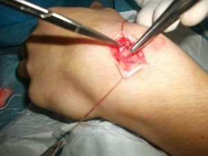 kirurgisk fjernelse af en tumor