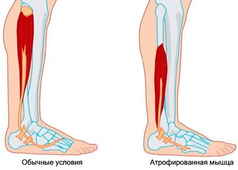 Atrophie der Beinmuskulatur. Behandlung, Medikamente, Salben