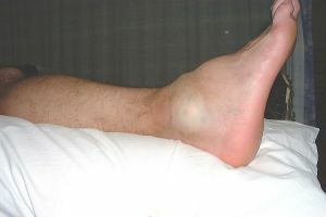 How to cure a foot injury in the home?