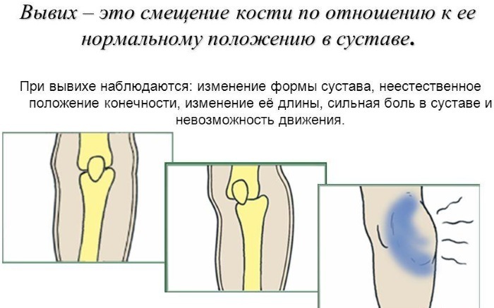 Lésions du système musculo-squelettique. Causes, premiers secours, classification, types, mesures préventives