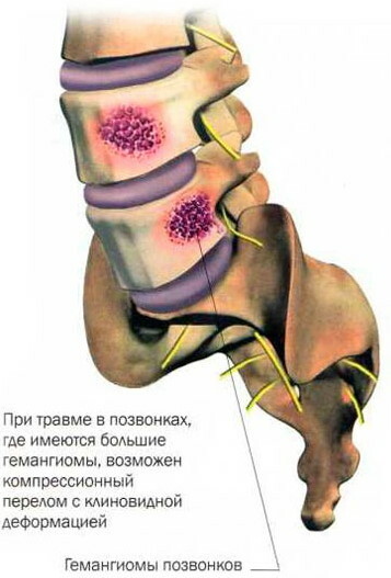 Hemangioma in the body of the vertebra l1-l2-l3-l4, th7-th10-th12. What it is