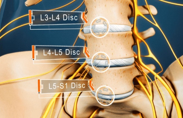 L5-S1 hernia. Where is a person, a photo, a diagram of the spine