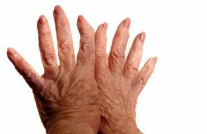poliartrozu ruku