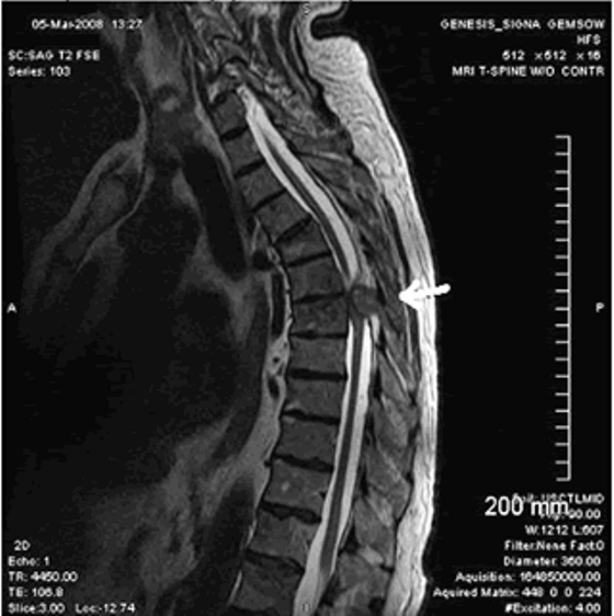 Ernia della colonna vertebrale toracica, risonanza magnetica