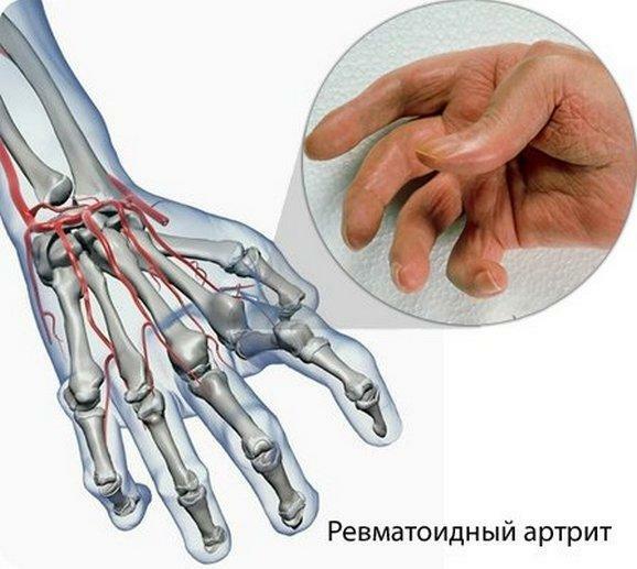 Artrite reumatóide nos últimos estágios