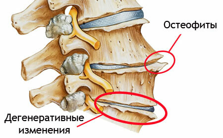 Spondylosis of the lumbosacral spine