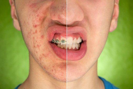 According to the study, more than half of Russians( 61.6%) in adolescence suffer from acne