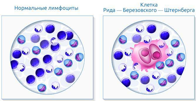 Hodgkin's disease (nodular sclerosis). What is it, analysis, pathogenesis, clinical guidelines