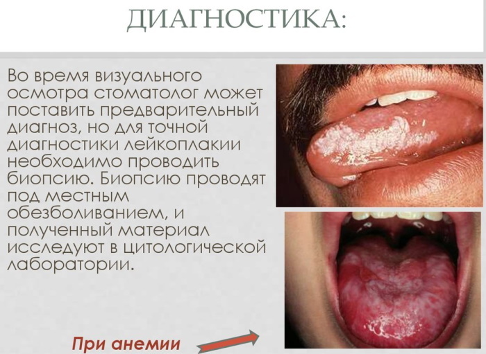 Leucoplasia de la cavidad bucal. Foto, diagnóstico diferencial