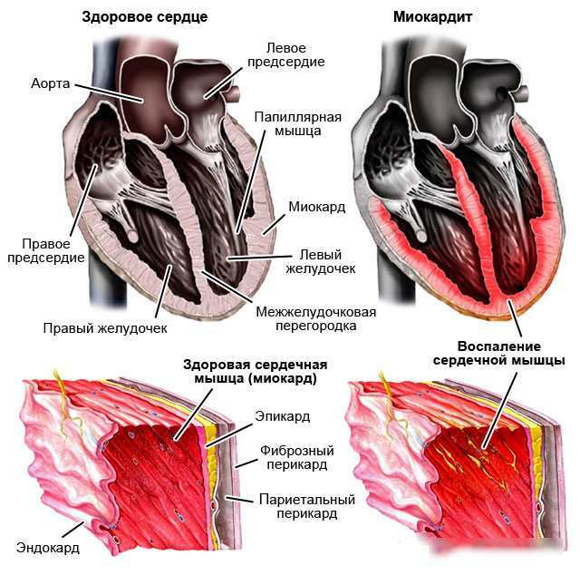 Myocarditis. Symptoms and treatment in adults, what is it, clinical guidelines, classification