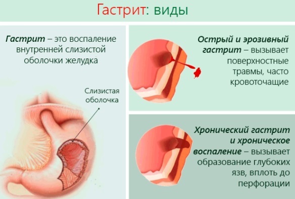 Medicina per la gastrite dello stomaco. Prezzi dei farmaci, recensioni