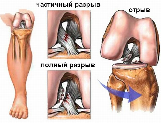Treatment and rehabilitation after the rupture of the anterior cruciate ligament of the knee