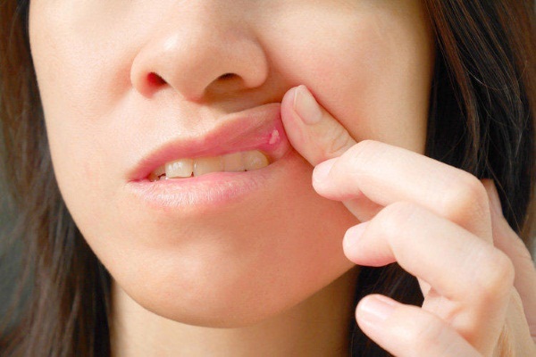 inflamación de la lengua: la glándula salival, herradura, papilas-protuberancias en los lados. fotos de tratamiento