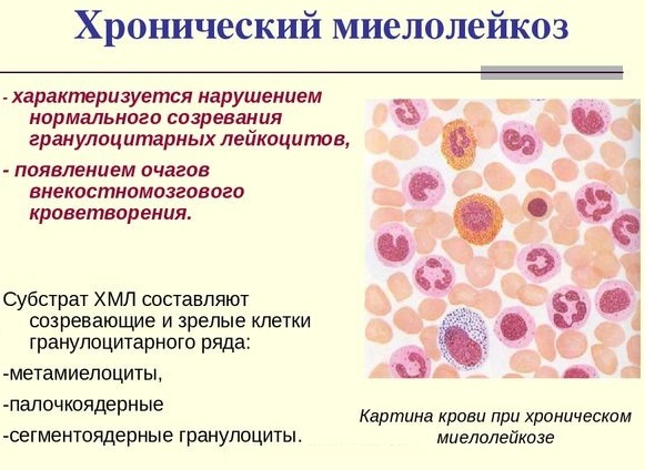 Myelocytes in a blood test. What is it in a child, an adult, the norm, elevated, decoding
