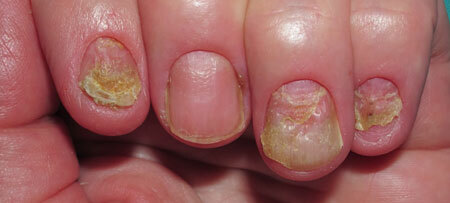 gevolgen van verwaarloosde vorm van schimmelinfectie van de nagels