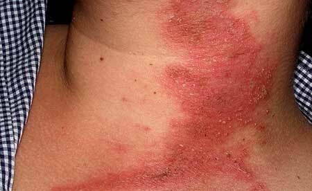 allergisk dermatitis hos voksne, foto 1