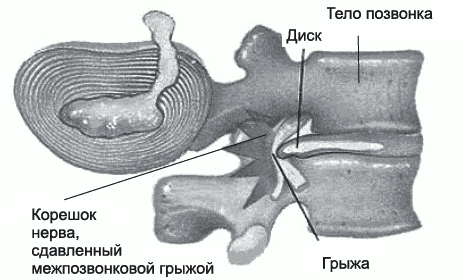 Treatment of a hernia of a backbone
