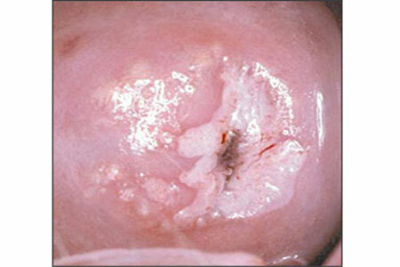 foto van cervicale uteriene leukoplakie bij onderzoek door een gynaecoloog