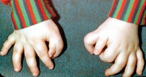 polydactyly and its causes
