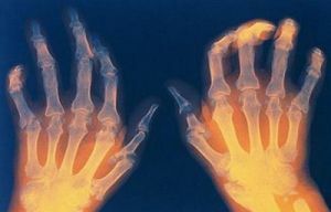 Revmatoidni artritis