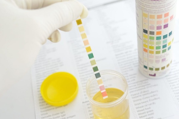Leukocyte esterase in urine. What does it mean, the norm