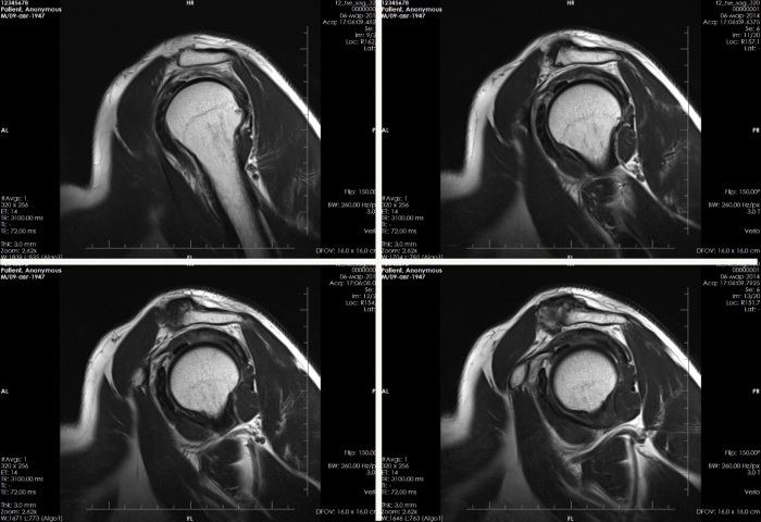 MRI of the shoulder joint. Price, which shows how the procedure is going, what can be found