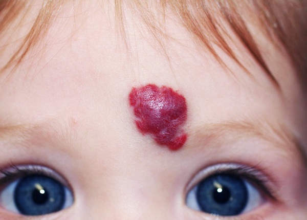 Hemangioma na face. Foto, o que é uma criança, adultos, causas, tratamento