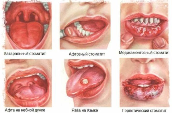 Den bedste salve på sår i munden hos voksne og børn. Priser, anmeldelser