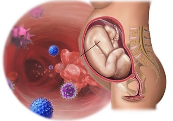 Infecciones intrauterinas en recién nacidos, feto durante el embarazo. Causas, consecuencias, que es, análisis