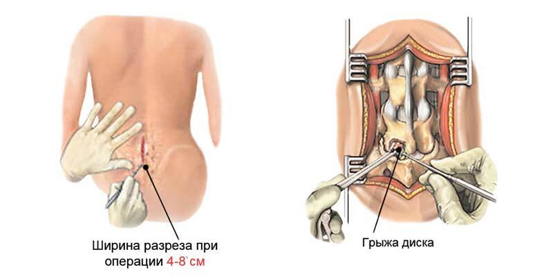 Kirurgi for å fjerne hernia i lumbosakral ryggraden