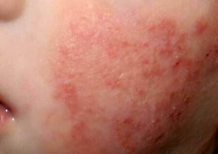 symptomer på allergisk dermatitis hos børn, foto 2