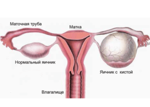 endometrioid