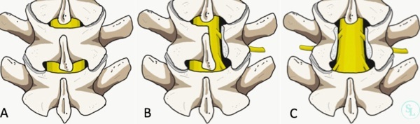 Spondylosis of the lumbosacral spine. What is it, symptoms, treatment, consequences