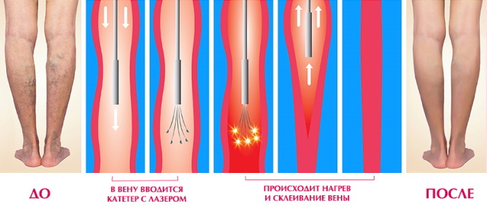 How to get rid of the mesh on the legs of the vascular, venous. Treatment