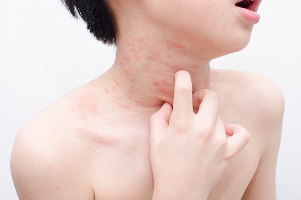 Cure for urticaria in adults: ointments, pills, medication injections. list of the best