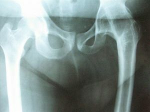 Comment et pourquoi l'arthroscopie de l'articulation de la hanche est-elle réalisée?