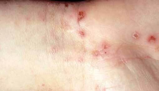 Scabies in adults: symptoms, photos first signs, treatment
