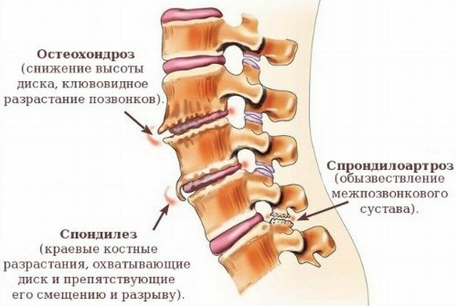 Signs and treatment of spondylarthrosis of the thoracic spine