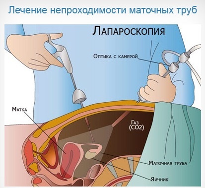 Obstruction of the fallopian tubes. What is it, causes, signs, treatment