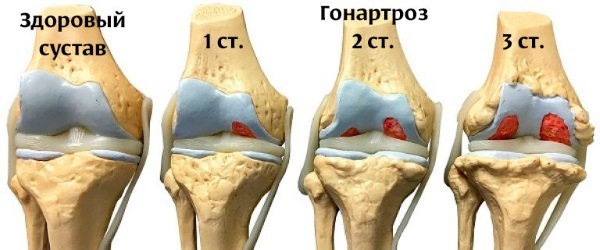 Gonartrosis primaria de la articulación bilateral de la rodilla. ¿Qué es, síntomas, tratamiento?