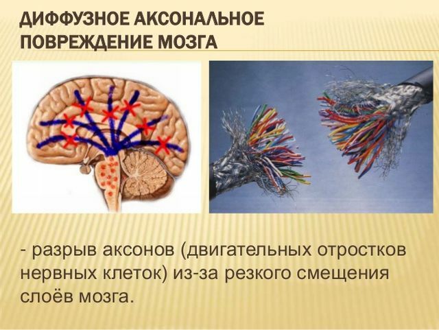 Razdrobljena aksonska poškodba možganov: simptomi, posledice, prognoze