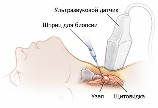 Biópsia tireoidiana