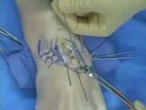 Operacija na ruku