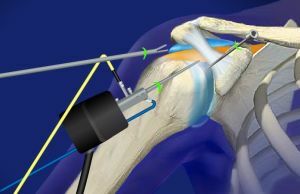arthroscopy of the shoulder joint