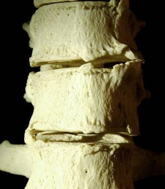 Osteofitas( espinas huesudas) de la columna vertebral