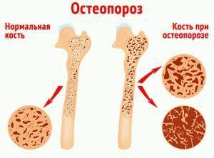 osteoporozė
