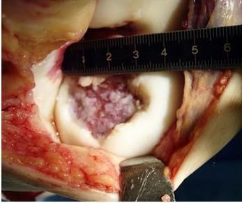 Defectul osteochondral al condilului medial al femurului cu osteochondrită disectivă( boala König)