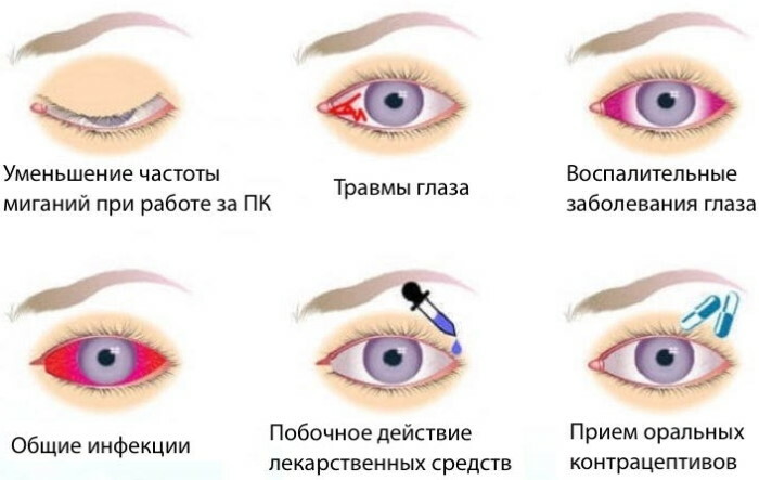 Dry eyes. Causes and treatment, drops